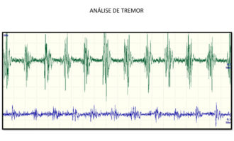 cortex-exame-eletroneuromiografia-1-330x200