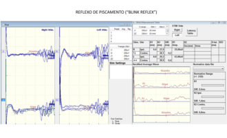 cortex-exame-eletroneuromiografia-3-330x200