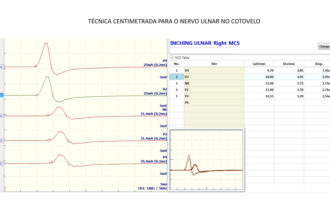 cortex-exame-eletroneuromiografia-4-330x200