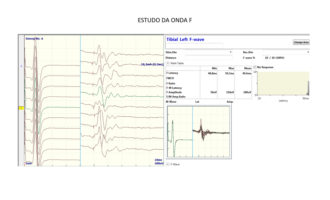 cortex-exame-eletroneuromiografia-5-330x200